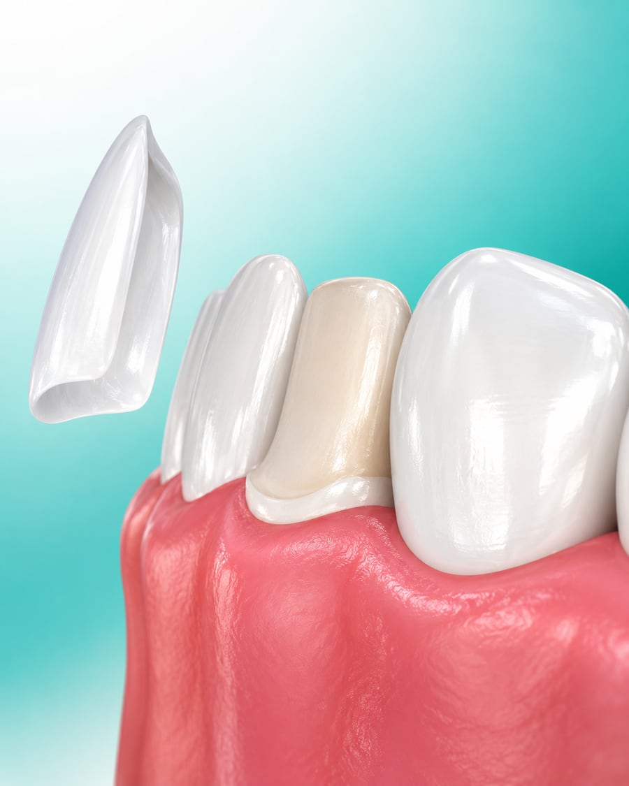 Illustration of a thin veneer being placed over a front tooth at Dr Ray & Partners Dental